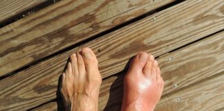 Jak leczyć płaskostopie w domu?